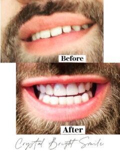 Man showing stained teeth in before photo and unstained teeth in after photo.