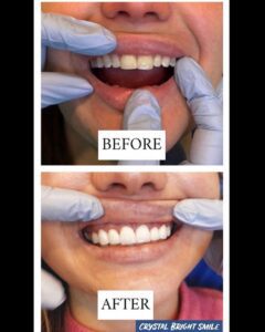 Female showing stained teeth in before photo and unstained teeth in after photo.