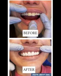 Female showing stained teeth in before photo and unstained teeth in after photo.
