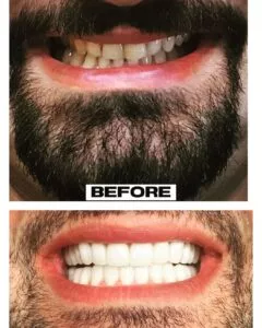 Man showing stained teeth in before photo and unstained teeth in after photo.