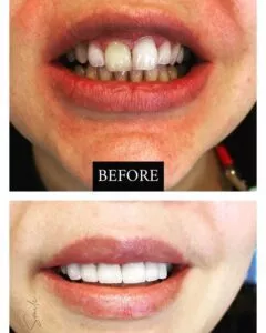 Child showing stained teeth in before photo and unstained teeth in after photo.