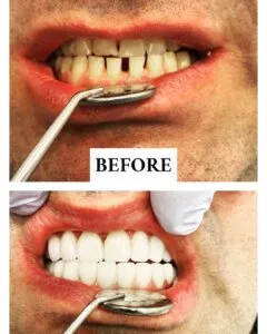 Male showing stained teeth in before photo and unstained teeth in after photo.