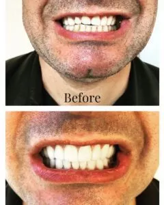 Male in black T-shirt showing crooked teeth in before photo and straight teeth in after photo. Before and after photos stacked vertically.